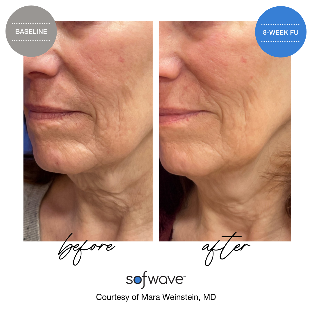 Sofwave™ Neck Rejuvenation